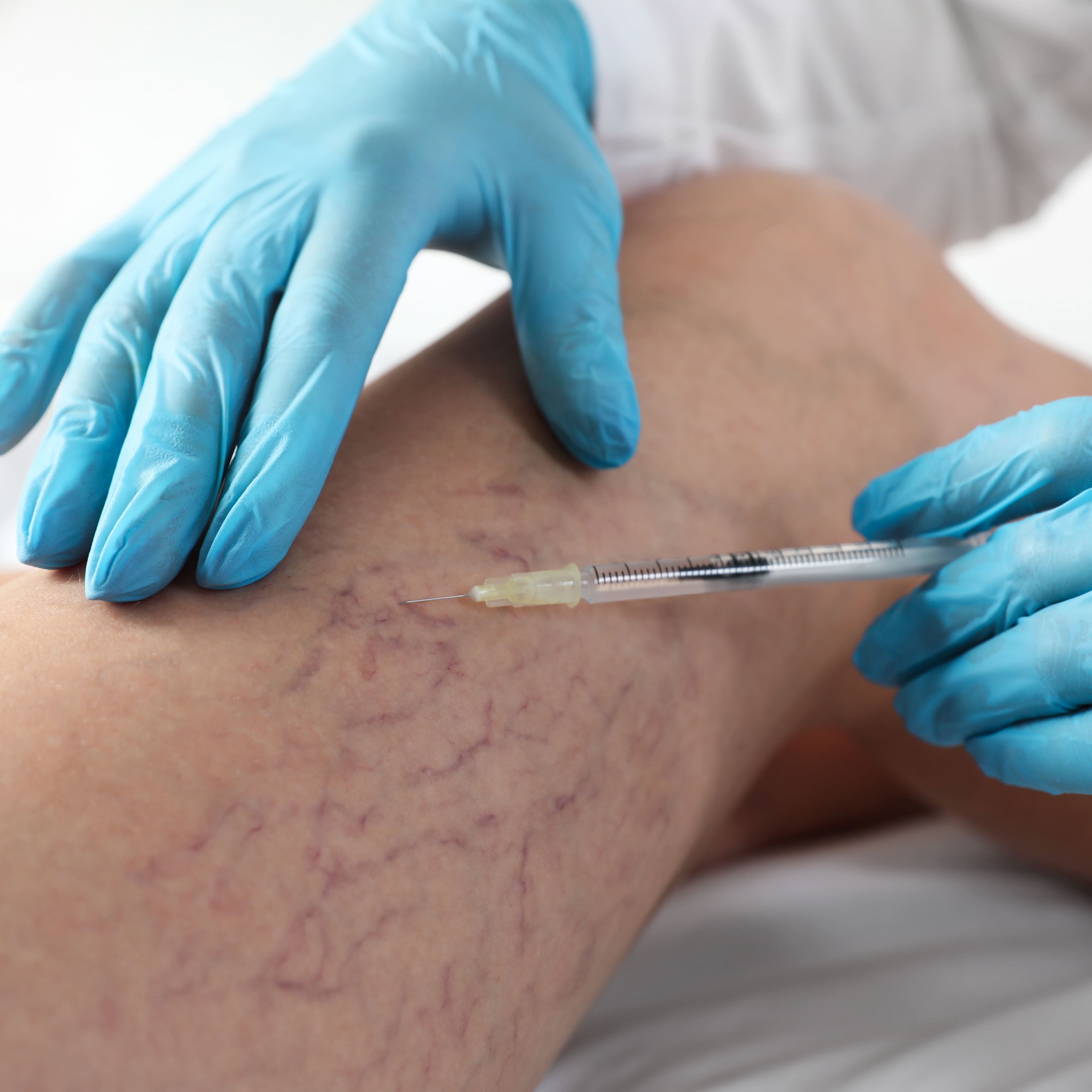 Traitement varices injection