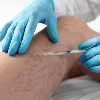 Traitement des varices par injection